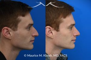 Photo of a patient before and after a procedure. Rhinoplasty for long and droopy tip and nasal hump - This young professional wanted improved breathing and enhancement of his nasal appearance. An open rhinoplasty  was used to lower the nasal bridge and narrow and elevate the nasal tip.