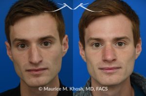 Photo of a patient before and after a procedure. Rhinoplasty for long and droopy tip and nasal hump - This young professional wanted improved breathing and enhancement of his nasal appearance. An open rhinoplasty  was used to lower the nasal bridge and narrow and elevate the nasal tip.