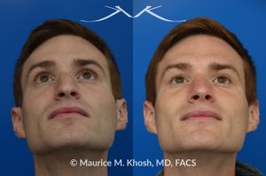 Photo of a patient before and after a procedure. Rhinoplasty for long and droopy tip and nasal hump - This young professional wanted improved breathing and enhancement of his nasal appearance. An open rhinoplasty  was used to lower the nasal bridge and narrow and elevate the nasal tip.