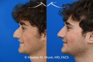 Photo of a patient before and after a procedure.  Rhinoplasty for nasal obstruction, large nasal hump, and droopy nasal tip - This young patient had a severely deviated septum which caused nasal obstruction. During an open rhinoplasty, the septum deviation was addressed. The nasal hump was reduced while preserving his overall facial appearance. The droopy nasal hump was corrected with the use of septo-columellar sutures. A small cartilage graft was applied to the excessively deep naso-forntal angle (radix). 
