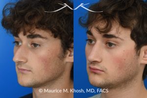 Photo of a patient before and after a procedure.  Rhinoplasty for nasal obstruction, large nasal hump, and droopy nasal tip - This young patient had a severely deviated septum which caused nasal obstruction. During an open rhinoplasty, the septum deviation was addressed. The nasal hump was reduced while preserving his overall facial appearance. The droopy nasal hump was corrected with the use of septo-columellar sutures. A small cartilage graft was applied to the excessively deep naso-forntal angle (radix). 