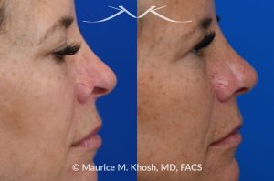 Photo of a patient before and after a procedure. Secondary repair of Moh's defect to corrent nostril retraction  - before and after photos.