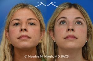 Photo of a patient before and after a procedure. Subtle rhinoplasty for dorsum deviation to the right side - This wonderful patient had a minor imperfection in her nose. The nasal dorsum deviated to the right side and she had a very minor bony hump. I used a closed rhinoplasty approach. The nasal hump was shaved. The dorsum deviation was addressed with spreader-graft application to the left side.