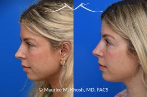 Photo of a patient before and after a procedure. Subtle rhinoplasty for dorsum deviation to the right side - This wonderful patient had a minor imperfection in her nose. The nasal dorsum deviated to the right side and she had a very minor bony hump. I used a closed rhinoplasty approach. The nasal hump was shaved. The dorsum deviation was addressed with spreader-graft application to the left side.