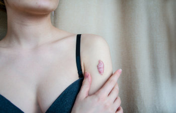 keloid scar on shoulder of woman