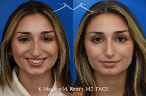 Photo of a patient before and after a procedure. Rhinoplasty for nasal obstruction - This young patient was interested in eliminating her nasal hump and improving her droopy appearing nasal tip. She was also interested in addressing her nasal breathing obstruction. An open approach rhinoplasty was used to achieve a smooth dorsal profile, and elevate and refine her nasal tip. Her deviated septum was also corrected during the surgery. 
