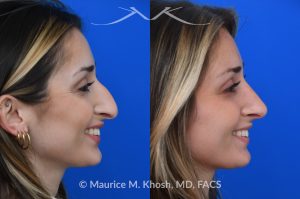 Photo of a patient before and after a procedure. Rhinoplasty for nasal obstruction - This young patient was interested in eliminating her nasal hump and improving her droopy appearing nasal tip. She was also interested in addressing her nasal breathing obstruction. An open approach rhinoplasty was used to achieve a smooth dorsal profile, and elevate and refine her nasal tip. Her deviated septum was also corrected during the surgery. 
