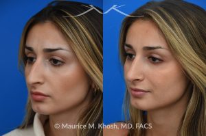 Photo of a patient before and after a procedure. Rhinoplasty for nasal obstruction - This young patient was interested in eliminating her nasal hump and improving her droopy appearing nasal tip. She was also interested in addressing her nasal breathing obstruction. An open approach rhinoplasty was used to achieve a smooth dorsal profile, and elevate and refine her nasal tip. Her deviated septum was also corrected during the surgery. 
