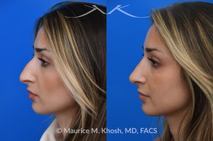 Photo of a patient before and after a procedure. Rhinoplasty for nasal obstruction - This young patient was interested in eliminating her nasal hump and improving her droopy appearing nasal tip. She was also interested in addressing her nasal breathing obstruction. An open approach rhinoplasty was used to achieve a smooth dorsal profile, and elevate and refine her nasal tip. Her deviated septum was also corrected during the surgery. 
