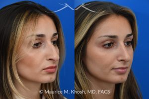 Photo of a patient before and after a procedure. Rhinoplasty for nasal obstruction - This young patient was interested in eliminating her nasal hump and improving her droopy appearing nasal tip. She was also interested in addressing her nasal breathing obstruction. An open approach rhinoplasty was used to achieve a smooth dorsal profile, and elevate and refine her nasal tip. Her deviated septum was also corrected during the surgery. 
