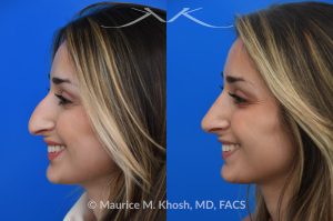 Photo of a patient before and after a procedure. Rhinoplasty for nasal obstruction - This young patient was interested in eliminating her nasal hump and improving her droopy appearing nasal tip. She was also interested in addressing her nasal breathing obstruction. An open approach rhinoplasty was used to achieve a smooth dorsal profile, and elevate and refine her nasal tip. Her deviated septum was also corrected during the surgery. 
