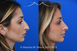 Photo of a patient before and after a procedure. Rhinoplasty for nasal obstruction - This young patient was interested in eliminating her nasal hump and improving her droopy appearing nasal tip. She was also interested in addressing her nasal breathing obstruction. An open approach rhinoplasty was used to achieve a smooth dorsal profile, and elevate and refine her nasal tip. Her deviated septum was also corrected during the surgery. 
