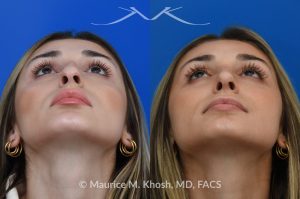 Photo of a patient before and after a procedure. Rhinoplasty  - This young patient was interested in eliminating her nasal hump and improving her droopy appearing nasal tip. She was also interested in addressing her nasal breathing obstruction. An open approach rhinoplasty was used to achieve a smooth dorsal profile, and elevate and refine her nasal tip. Her deviated septum was also corrected during the surgery. 
