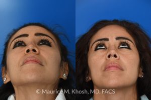 Photo of a patient before and after a procedure. saddle nose rhinoplasty - This patient had previously undergone an unsuccessful rhinoplasty surgery with cadaver rib cartilage graft. She had developed a saddle collapse of her nose and loss of nasal tip definition. Her own rib and temporalis fascia was used to reconstruct the nose. She is ecstatic with her results at 6 months post op. 