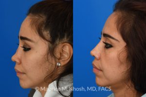 Photo of a patient before and after a procedure. saddle nose rhinoplasty - This patient had previously undergone an unsuccessful rhinoplasty surgery with cadaver rib cartilage graft. She had developed a saddle collapse of her nose and loss of nasal tip definition. Her own rib and temporalis fascia was used to reconstruct the nose. She is ecstatic with her results at 6 months post op. 