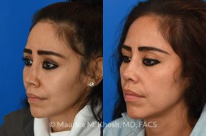 Photo of a patient before and after a procedure. saddle nose rhinoplasty - This patient had previously undergone an unsuccessful rhinoplasty surgery with cadaver rib cartilage graft. She had developed a saddle collapse of her nose and loss of nasal tip definition. Her own rib and temporalis fascia was used to reconstruct the nose. She is ecstatic with her results at 6 months post op. 