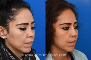 Photo of a patient before and after a procedure. saddle nose rhinoplasty - This patient had previously undergone an unsuccessful rhinoplasty surgery with cadaver rib cartilage graft. She had developed a saddle collapse of her nose and loss of nasal tip definition. Her own rib and temporalis fascia was used to reconstruct the nose. She is ecstatic with her results at 6 months post op. 