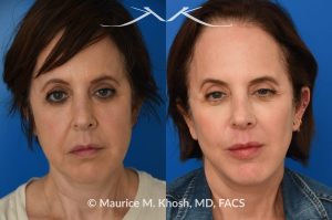 Photo of a patient before and after a procedure. Facelift and Buccal Fat Removal - This 54-year-old was unhappy with the 'heavy' and aged appearance of her lower face. A combination of short-flap facelift and buccal fat removal (performed under local anesthesia) was used to restore the  youthful and heart-shaped contour of the lower face.