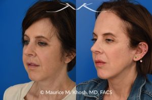 Photo of a patient before and after a procedure. Facelift and Buccal Fat Removal - This 54-year-old was unhappy with the 'heavy' and aged appearance of her lower face. A combination of short-flap facelift and buccal fat removal (performed under local anesthesia) was used to restore the  youthful and heart-shaped contour of the lower face.