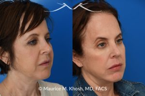 Photo of a patient before and after a procedure. Facelift and Buccal fat removal - This 54-year-old was unhappy with the 'heavy' and aged appearance of her lower face. A combination of short-flap facelift and buccal fat removal (performed under local anesthesia) was used to restore the  youthful and heart-shaped contour of the lower face.
