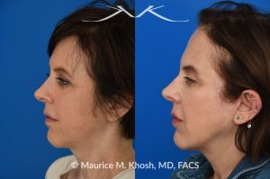 Photo of a patient before and after a procedure. Facelift and Buccal fat removal - This 54-year-old was unhappy with the 'heavy' and aged appearance of her lower face. A combination of short-flap facelift and buccal fat removal (performed under local anesthesia) was used to restore the  youthful and heart-shaped contour of the lower face.