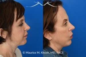 Photo of a patient before and after a procedure. Facelift and Buccal Fat Removal - This 54-year-old was unhappy with the 'heavy' and aged appearance of her lower face. A combination of short-flap facelift and buccal fat removal (performed under local anesthesia) was used to restore the  youthful and heart-shaped contour of the lower face.