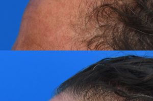 Photo of a patient before and after a procedure. Osteoma Forehead - This gentleman had a large osteoma of the forehead which made him very self conscious. He always wore hats to hide his forehead. The excess bone was removed through a perfectly hidden incision in his hairline. 
