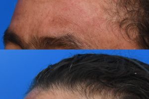 Photo of a patient before and after a procedure. Osteoma Forehead - This gentleman had a large osteoma of the forehead which made him very self conscious. He always wore hats to hide his forehead. The excess bone was removed through a perfectly hidden incision in his hairline. 