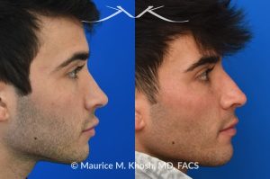 Photo of a patient before and after a procedure. Revision Rhinoplasty for scooped appearing nose - This young patient has previously undergone rhinoplasty, which resulted in an over-resected nasal bridge with a 'scooped slope'. He wanted revision rhinoplasty to restore the natural height and contour to the bridge of his nose. He also wanted to reduce the nasal tip rotation. We used his septal cartilage and ear cartilage to restore the nose. He is ecstatic with his results. 