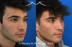 Photo of a patient before and after a procedure. Revision Rhinoplasty for scooped appearing nose - This young patient has previously undergone rhinoplasty, which resulted in an over-resected nasal bridge with a 'scooped slope'. He wanted revision rhinoplasty to restore the natural height and contour to the bridge of his nose. He also wanted to reduce the nasal tip rotation. We used his septal cartilage and ear cartilage to restore the nose. He is ecstatic with his results. 