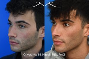 Photo of a patient before and after a procedure. Revision Rhinoplasty for scooped appearing nose - This young patient has previously undergone rhinoplasty, which resulted in an over-resected nasal bridge with a 'scooped slope'. He wanted revision rhinoplasty to restore the natural height and contour to the bridge of his nose. He also wanted to reduce the nasal tip rotation. We used his septal cartilage and ear cartilage to restore the nose. He is ecstatic with his results. 