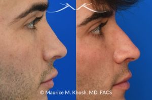 Photo of a patient before and after a procedure. Revision Rhinoplasty for scooped appearing nose - This young patient has previously undergone rhinoplasty, which resulted in an over-resected nasal bridge with a 'scooped slope'. He wanted revision rhinoplasty to restore the natural height and contour to the bridge of his nose. He also wanted to reduce the nasal tip rotation. We used his septal cartilage and ear cartilage to restore the nose. He is ecstatic with his results. 