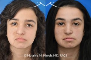 Photo of a patient before and after a procedure. Rhinoplasty Crooked Nose - This young patient had suffered from hemangioma (abnormal blood vessel growth in the skin) of the right side of the face, which required multiple surgeries to fully remove. The hemangioma and previous surgeries resulted in deviation of her nose to the right side as well as nasal obstruction. Revision rhinoplasty helped to straighten the nose into a more normal position. 