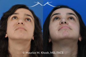 Photo of a patient before and after a procedure. Rhinoplasty Crooked Nose - This young patient had suffered from hemangioma (abnormal blood vessel growth in the skin) of the right side of the face, which required multiple surgeries to fully remove. The hemangioma and previous surgeries resulted in deviation of her nose to the right side as well as nasal obstruction. Revision rhinoplasty helped to straighten the nose into a more normal position. 
