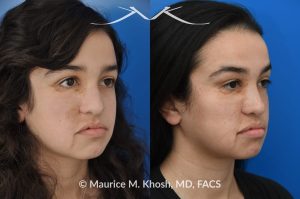 Photo of a patient before and after a procedure. Rhinoplasty Crooked Nose - This young patient had suffered from hemangioma (abnormal blood vessel growth in the skin) of the right side of the face, which required multiple surgeries to fully remove. The hemangioma and previous surgeries resulted in deviation of her nose to the right side as well as nasal obstruction. Revision rhinoplasty helped to straighten the nose into a more normal position. 