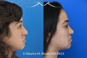 Photo of a patient before and after a procedure. Rhinoplasty Crooked Nose - This young patient had suffered from hemangioma (abnormal blood vessel growth in the skin) of the right side of the face, which required multiple surgeries to fully remove. The hemangioma and previous surgeries resulted in deviation of her nose to the right side as well as nasal obstruction. Revision rhinoplasty helped to straighten the nose into a more normal position. 