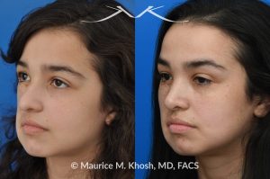 Photo of a patient before and after a procedure. Rhinoplasty Crooked Nose - This young patient had suffered from hemangioma (abnormal blood vessel growth in the skin) of the right side of the face, which required multiple surgeries to fully remove. The hemangioma and previous surgeries resulted in deviation of her nose to the right side as well as nasal obstruction. Revision rhinoplasty helped to straighten the nose into a more normal position. 