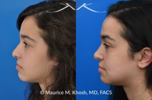 Photo of a patient before and after a procedure. Rhinoplasty Crooked Nose - This young patient had suffered from hemangioma (abnormal blood vessel growth in the skin) of the right side of the face, which required multiple surgeries to fully remove. The hemangioma and previous surgeries resulted in deviation of her nose to the right side as well as nasal obstruction. Revision rhinoplasty helped to straighten the nose into a more normal position. 