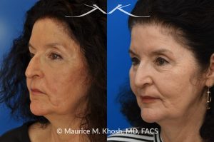 Photo of a patient before and after a procedure. Upper lip scar revision  - This patient had suffered an injury to her lip, which was repaired in the emergency room. She disliked the obvious and raised appearance of the scar. Scar revision surgery as an in-office procedure allowed us to make the scar almost invisible. 