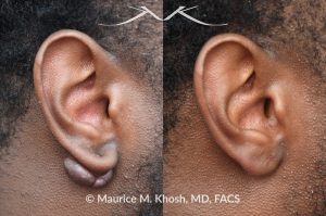 Photo of a patient before and after a procedure. Keloid of the right earlobe - Keloid was successfully removed during an office procedure in the office. The earlobe is now perfectly normal looking.