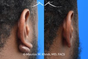 Photo of a patient before and after a procedure. Keloid of the right earlobe - Keloid was successfully removed during an office procedure in the office. The earlobe is now perfectly normal looking.