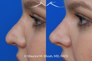 Photo of a patient before and after a procedure. Liquid rhinoplasty - This lovely patient was interested in non-surgical rhinoplasty to smooth the dorsal profile, and enhance the nasal tip appearance. Liquid rhinoplasty was performed in our Manhattan location during a routine office visit. Filler injections were used to elevate and refine the tip, and enhance the dorsal profile.