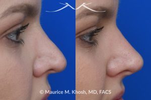 Photo of a patient before and after a procedure. Liquid rhinoplasty - This lovely patient was interested in non-surgical rhinoplasty to smooth the dorsal profile, and enhance the nasal tip appearance. Liquid rhinoplasty was performed in our Manhattan location during a routine office visit. Filler injections were used to elevate and refine the tip, and enhance the dorsal profile.