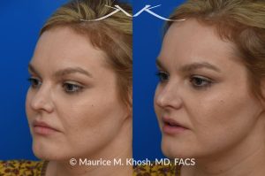 Photo of a patient before and after a procedure. Liquid rhinoplasty - This lovely patient was interested in non-surgical rhinoplasty to smooth the dorsal profile, and enhance the nasal tip appearance. Liquid rhinoplasty was performed in our Manhattan location during a routine office visit. Filler injections were used to elevate and refine the tip, and enhance the dorsal profile.