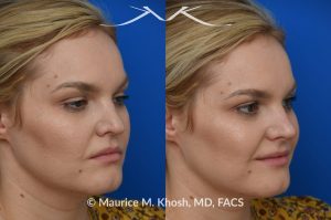 Photo of a patient before and after a procedure. Liquid rhinoplasty - This lovely patient was interested in non-surgical rhinoplasty to smooth the dorsal profile, and enhance the nasal tip appearance. Liquid rhinoplasty was performed in our Manhattan location during a routine office visit. Filler injections were used to elevate and refine the tip, and enhance the dorsal profile.