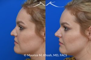 Photo of a patient before and after a procedure. Liquid rhinoplasty - This lovely patient was interested in non-surgical rhinoplasty to smooth the dorsal profile, and enhance the nasal tip appearance. Liquid rhinoplasty was performed in our Manhattan location during a routine office visit. Filler injections were used to elevate and refine the tip, and enhance the dorsal profile.