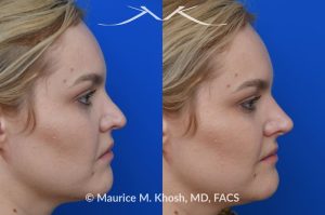 Photo of a patient before and after a procedure. Liquid rhinoplasty - This lovely patient was interested in non-surgical rhinoplasty to smooth the dorsal profile, and enhance the nasal tip appearance. Liquid rhinoplasty was performed in our Manhattan location during a routine office visit. Filler injections were used to elevate and refine the tip, and enhance the dorsal profile.