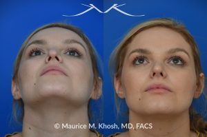 Photo of a patient before and after a procedure. Liquid rhinoplasty - This lovely patient was interested in non-surgical rhinoplasty to smooth the dorsal profile, and enhance the nasal tip appearance. Liquid rhinoplasty was performed in our Manhattan location during a routine office visit. Filler injections were used to elevate and refine the tip, and enhance the dorsal profile.