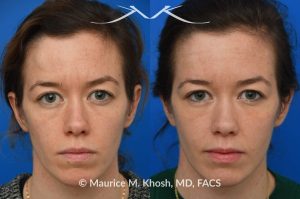 Photo of a patient before and after a procedure. Osteoma Forehead - The bony hump in the right upper forehead (an osteoma) was successfully treated through a hairline incision with a perfectly hidden scar within the hairline.