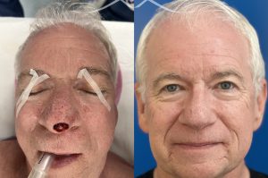 Photo of a patient before and after a procedure. This lovely patient underwent Mohs excision of basal cell carcinoma of the nasal tip. The defect was repaired with a local flap of nasal skin. The surgery actually helped to improve the nasal appearance by slightly elevating the tip.  - before and after photos.